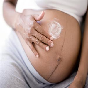 ترک های پوستی در بارداری